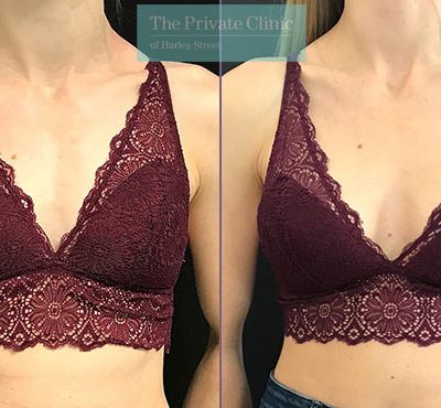 Breast Enlargement: The Rise of the Modern Minimalist Look