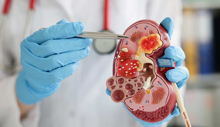 What Is a Nefrologist and Why Might You Need One?