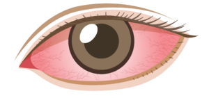 Human Infected Eye Png