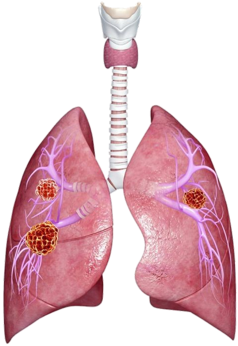 lung-15